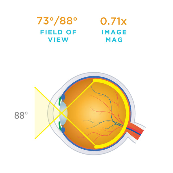 Retinal Lens