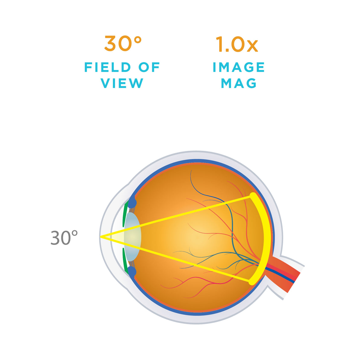 Volk HR Direct 1X - Surgical Vitrectomy Lens
