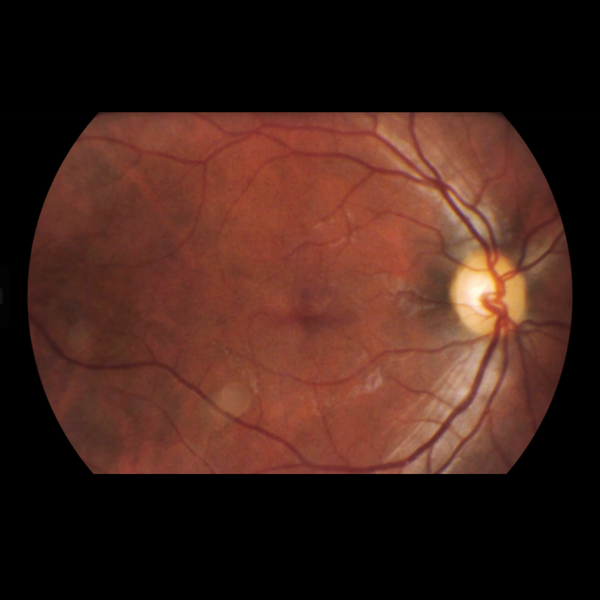 Viva Non-Mydriatic Handheld Retinal Camera