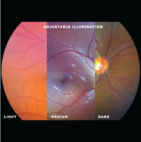 Successfully image patients from all populations, including darker retinas, while maintaining patient comfort with user-adjustable illumination levels. Ideal for accommodating photophobic patients. Capture clear, bright fundus images wherever you are and whoever you are imaging!