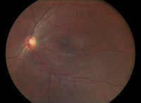 Pictor Prestige™ Portable Fundus Camera with Optional Anterior Module Vision 2
