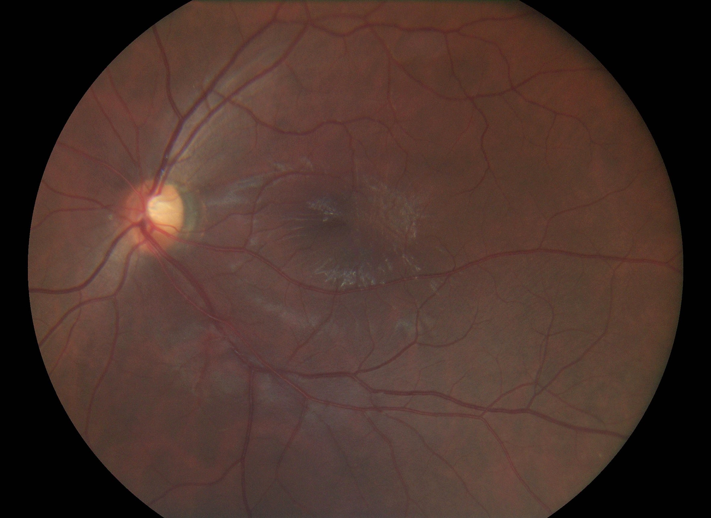 Pictor Prestige™ Portable Fundus Camera with Optional Anterior Module Vision 2