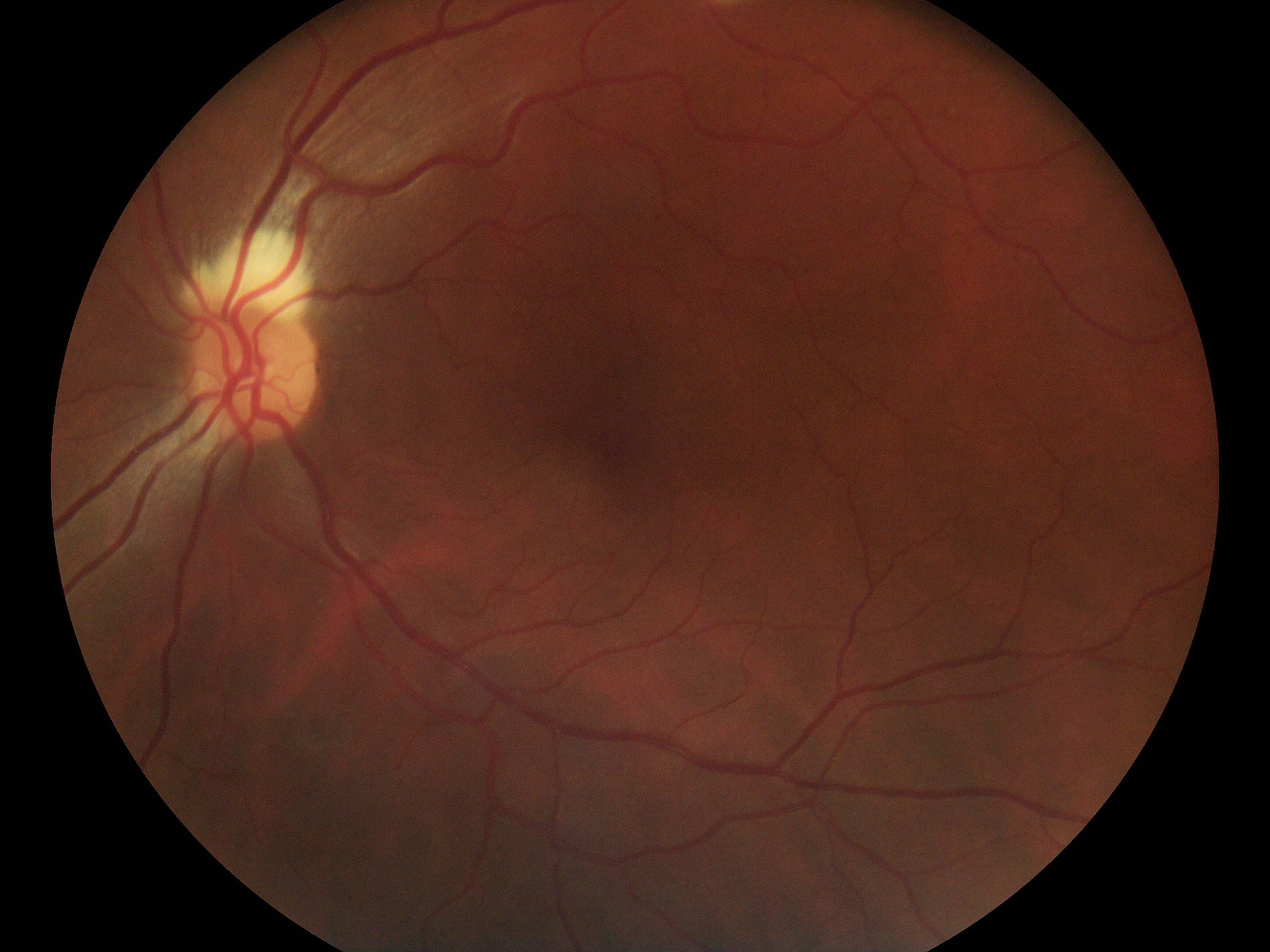 Pictor Prestige™ Portable Fundus Camera with Optional Anterior Module Vison