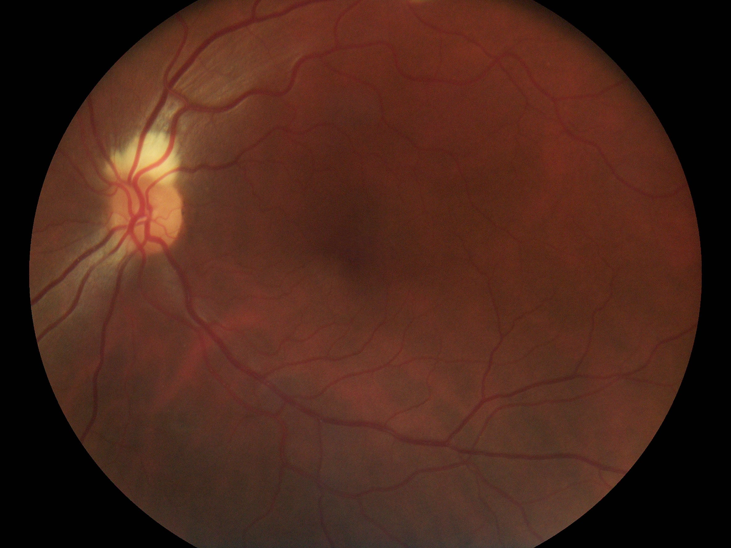 Pictor Prestige™ Portable Fundus Camera with Optional Anterior Module Vison