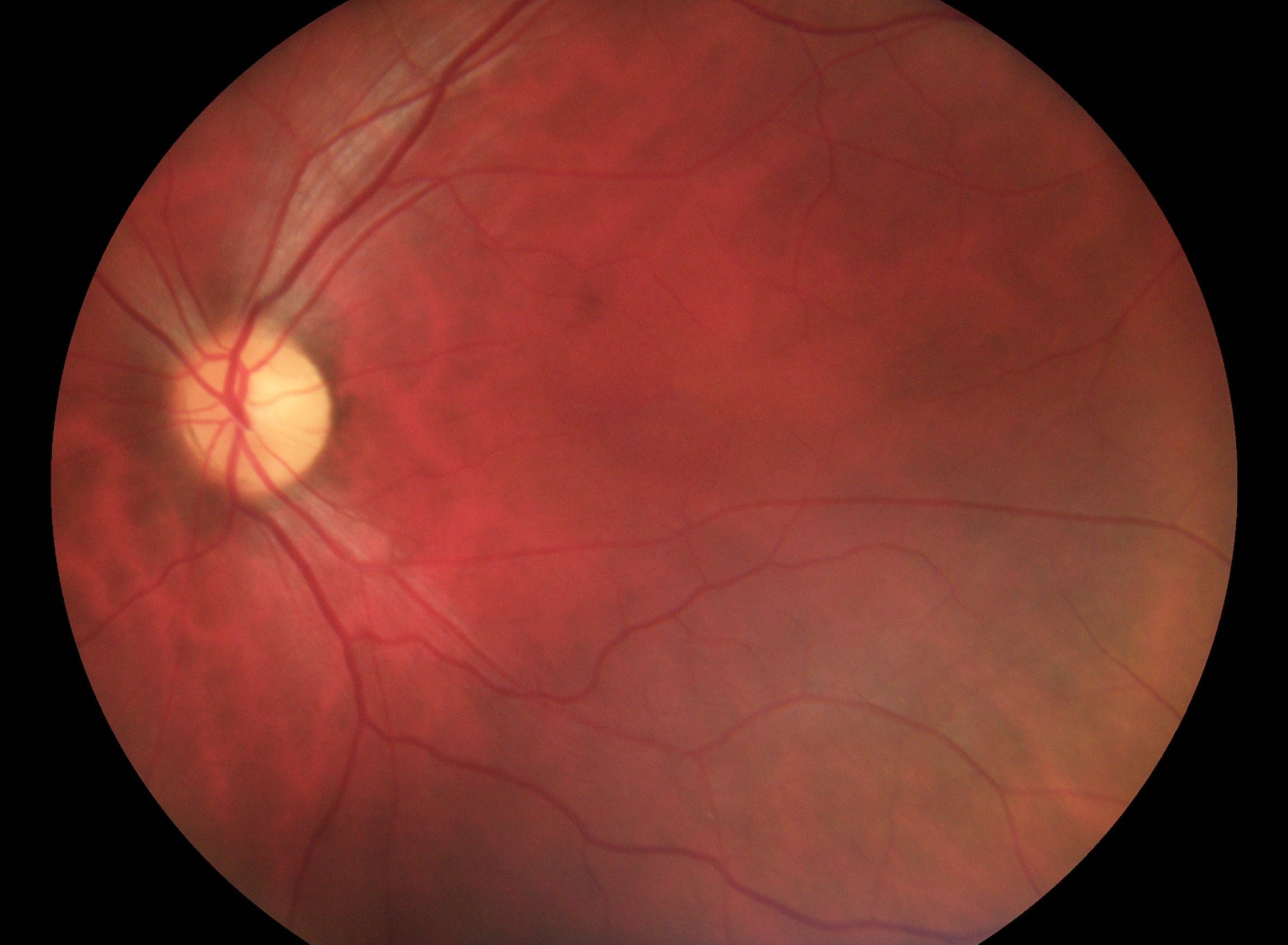 Pictor Prestige™ Portable Fundus Camera with Optional Anterior Module Vision 4