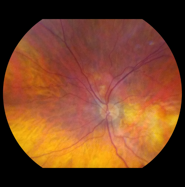 VistaView offers you the widest field of view in its class with 55˚ field of view of the retina in a single capture and even more with dynamic imaging. 