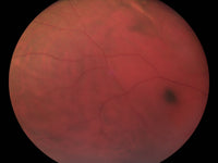 Pictor Prestige™ Portable Fundus Camera with Optional Anterior Module Vision 3